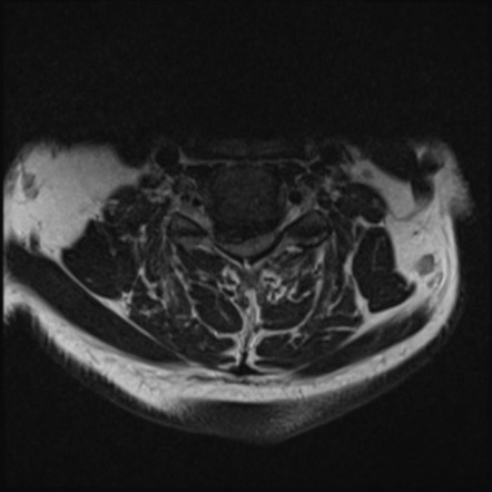 Cervical canal stenosis due to ossification of the posterior ...