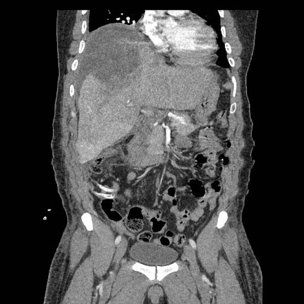 Liver Laceration Post Blunt Trauma Radiology Case Radiopaedia Org