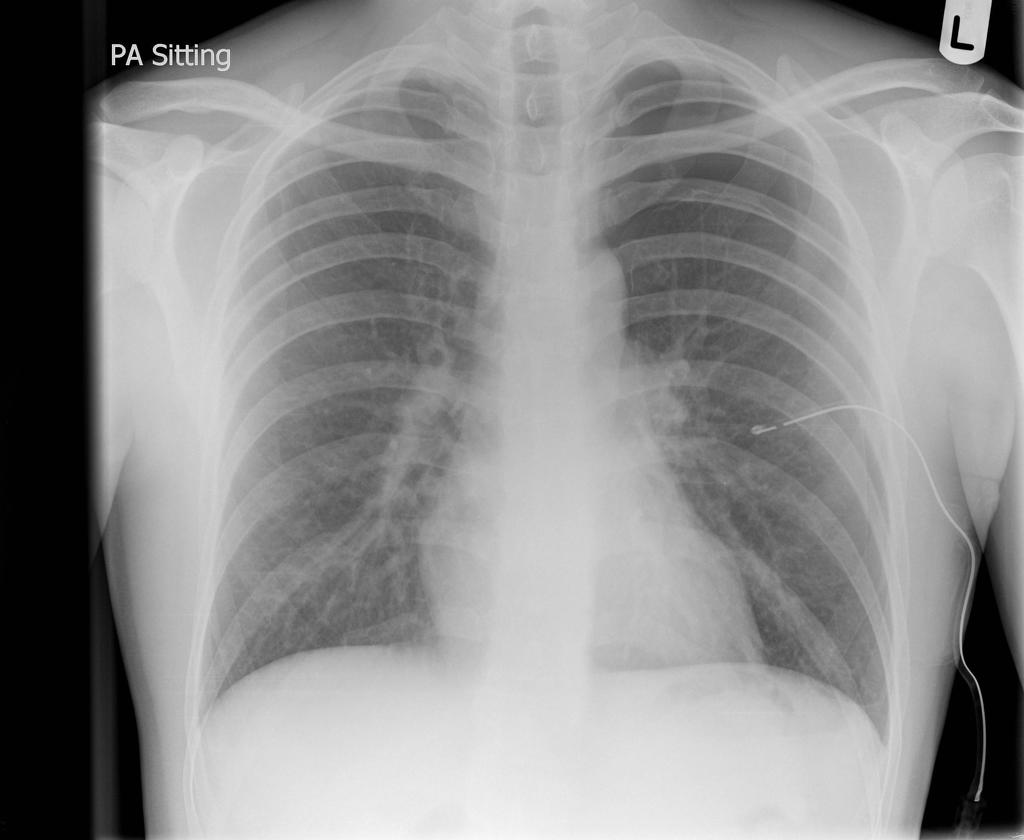 Spontaneous Pneumothorax Radiology Case Radiopaedia Org