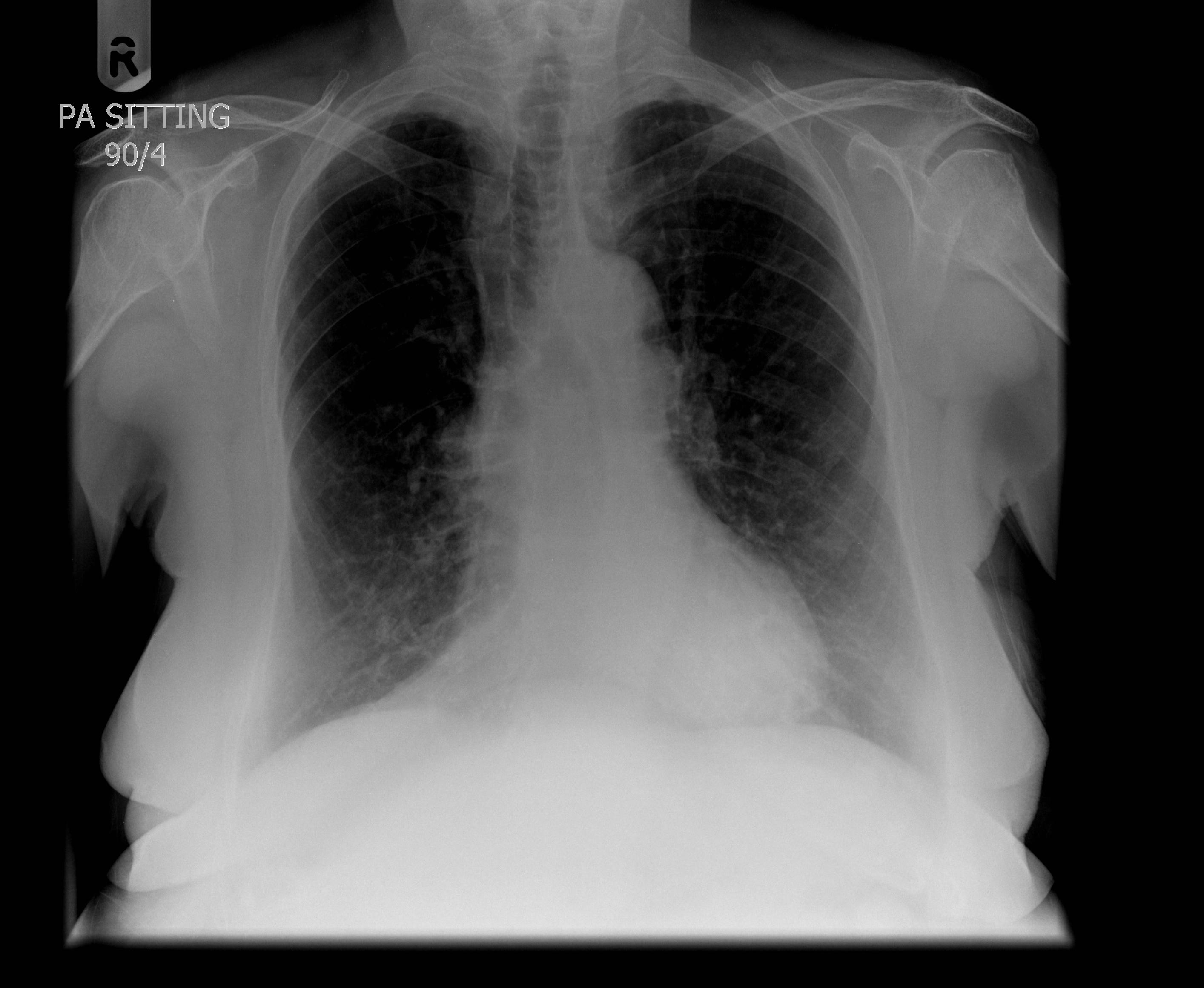 tracheal-calcification-image-radiopaedia