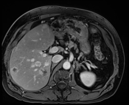 Angiosarcoma 