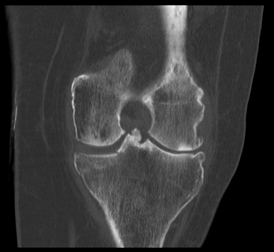 Medial tibial plateau fracture | Image | Radiopaedia.org