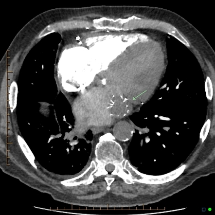 Left atrial appendage closure device, Image