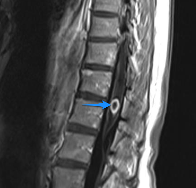 Spinal cord metastasis | Image | Radiopaedia.org