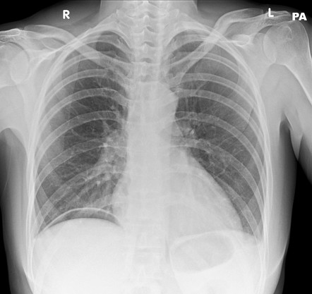 Postoperative free intraperitoneal gas | Radiology Reference Article ...