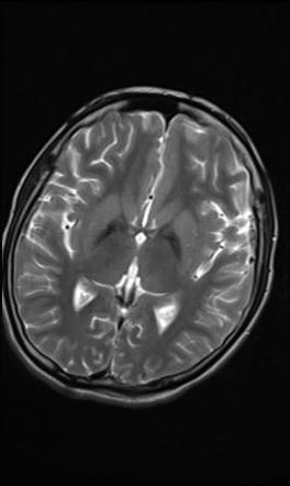 Eye Of The Tiger Sign Globus Pallidus Radiology Reference Article Radiopaedia Org