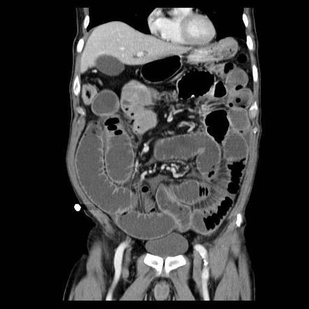 D Norma Ramos: Small Bowel Obstruction Ct With Oral Contrast