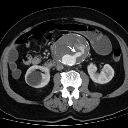 Thrombus fissuration sign (aortic aneurysm) | Radiology Reference ...