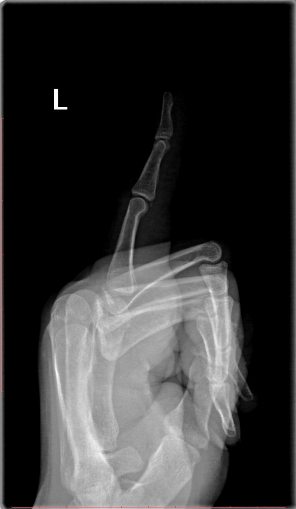 5th finger PIP joint fracture dislocation with volar plate fracture ...