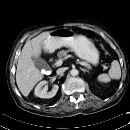 Gallbladder Stones Ct Scan Ct Scan Machine | SexiezPicz Web Porn