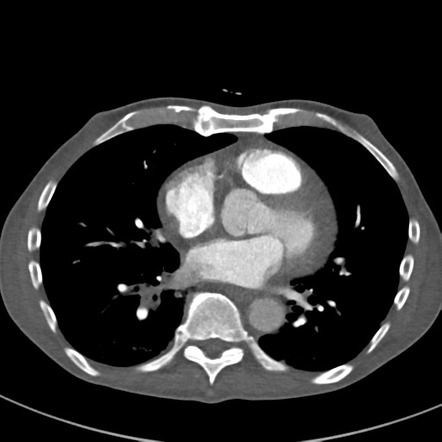 Scleroderma-related lung changes | Image | Radiopaedia.org