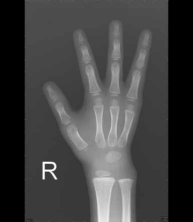 Tetradactyly | Radiology Case | Radiopaedia.org