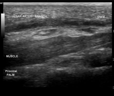 Hypothenar hammer syndrome | Image | Radiopaedia.org