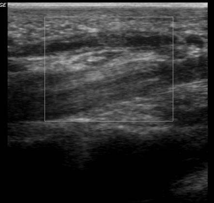 Hypothenar hammer syndrome | Image | Radiopaedia.org