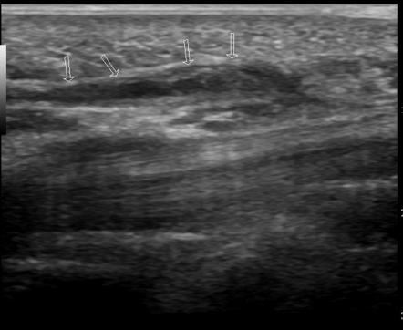 Hypothenar hammer syndrome | Image | Radiopaedia.org