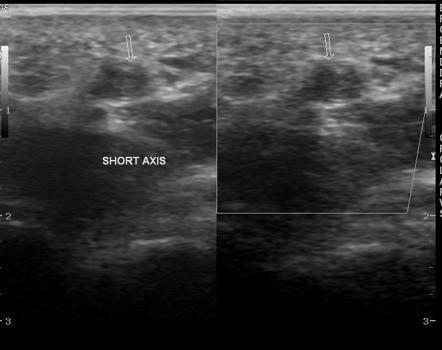 Hypothenar hammer syndrome | Image | Radiopaedia.org