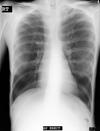 Kommerell diverticulum | Radiology Reference Article | Radiopaedia.org