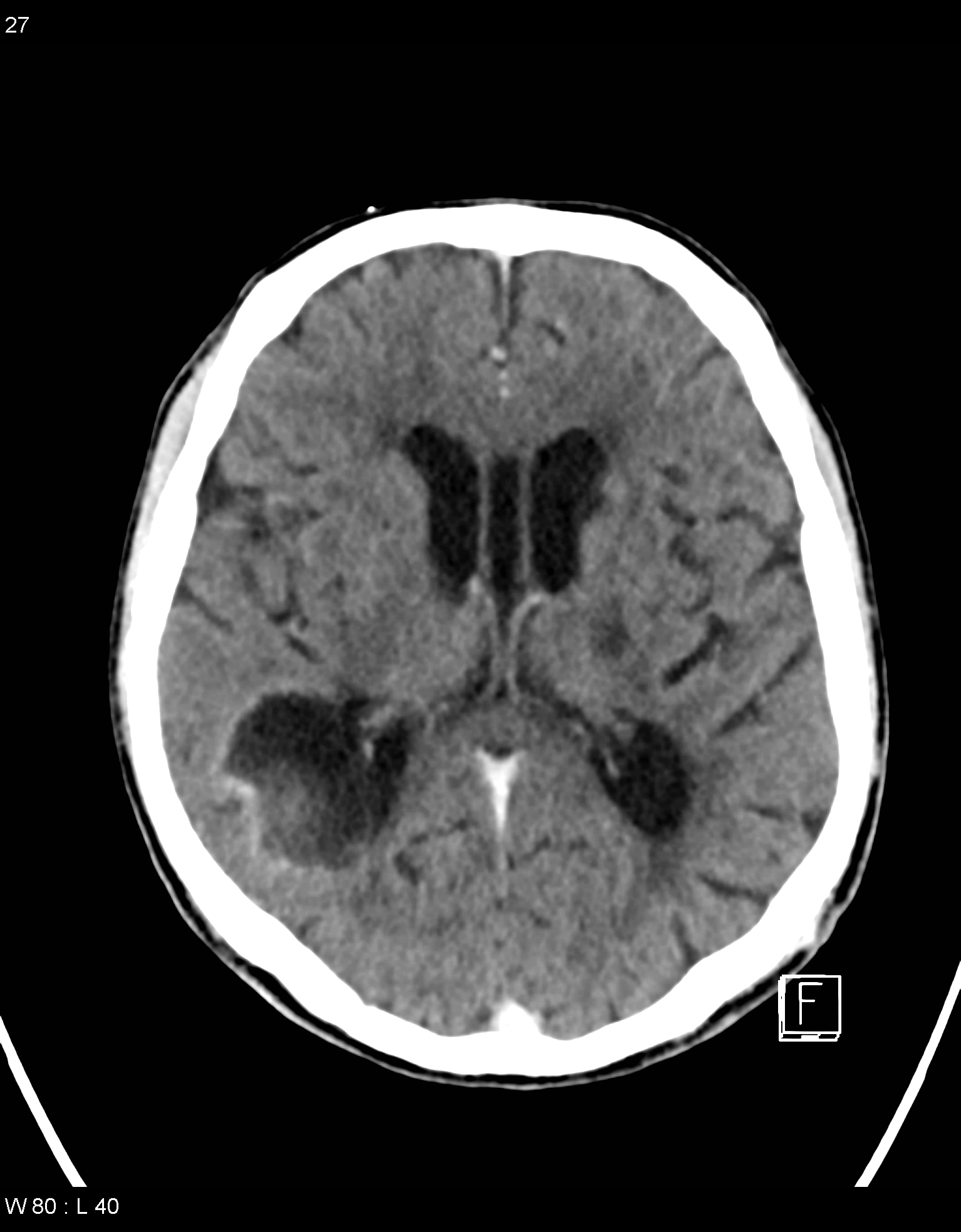 Subacute Intracranial Hemorrhage Image