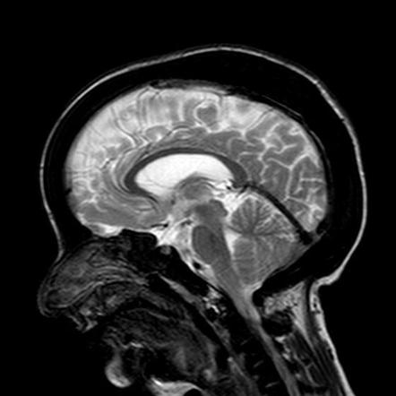 Calvarial thickening | Radiology Reference Article | Radiopaedia.org