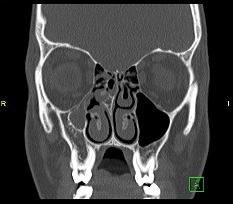 Silent sinus syndrome | Image | Radiopaedia.org