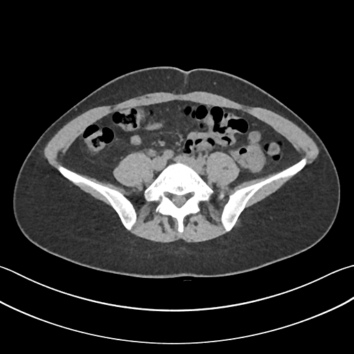 Right Lower Ureteric Calculus Icd Code 2024 - Faina Grissel