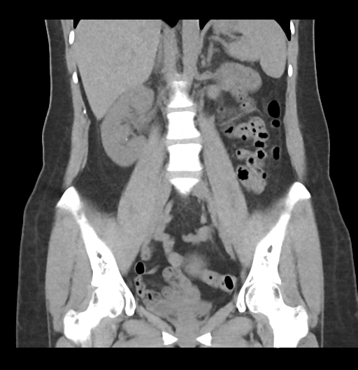 Distal right ureteric calculus Image