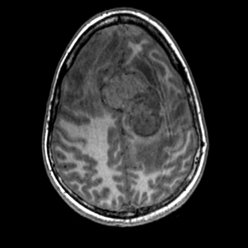 Solitary fibrous tumor (hemangiopericytoma) | Image | Radiopaedia.org