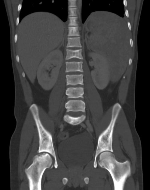 Splenomegaly | Radiology Reference Article | Radiopaedia.org