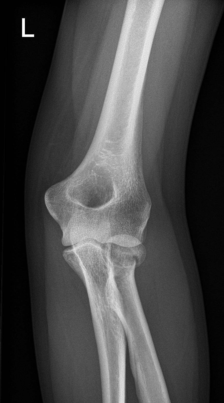 Radial head fracture | Image | Radiopaedia.org