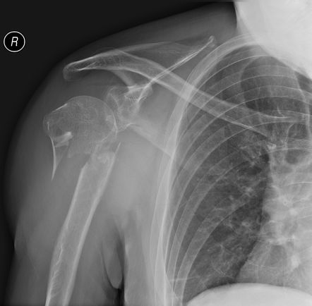 Lipohemarthrosis of the shoulder | Radiology Case | Radiopaedia.org