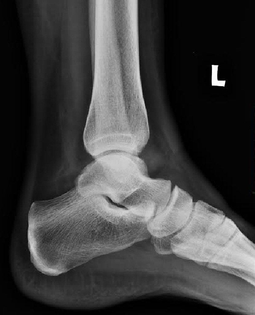 Ankle Teardrop Sign Radiology Case Radiopaedia Org