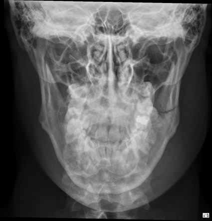 Mandibular fracture | Radiology Case | Radiopaedia.org