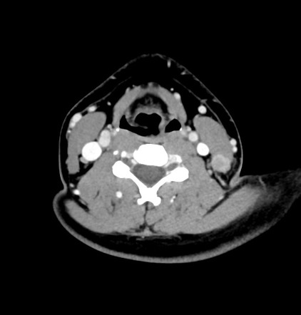 Nodular fasciitis | Radiology Case | Radiopaedia.org