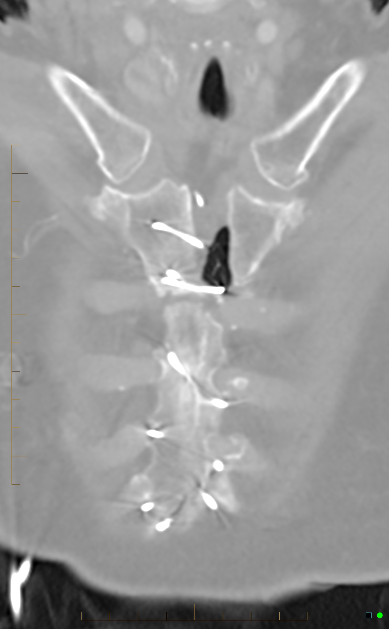 Dehiscent Manubrium Post Cabg Surgery With Lung Herniation Image