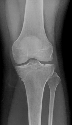 Tibial plateau and patellar fracture with lipohemarthrosis | Radiology ...