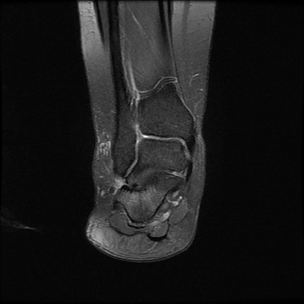 Extra-articular hindfoot impingement syndrome | Image | Radiopaedia.org