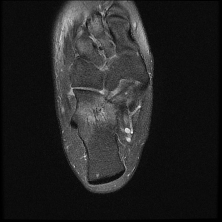 Extra-articular hindfoot impingement syndrome | Image | Radiopaedia.org