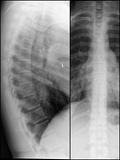 Thoracic Spine (AP View) | Radiology Reference Article | Radiopaedia.org