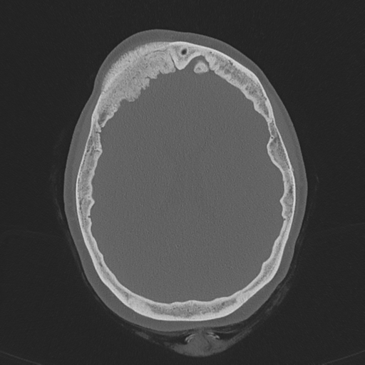 Intraosseous meningioma | Image | Radiopaedia.org