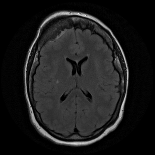 Intraosseous meningioma | Image | Radiopaedia.org