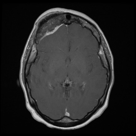 Intraosseous meningioma | Radiology Reference Article | Radiopaedia.org