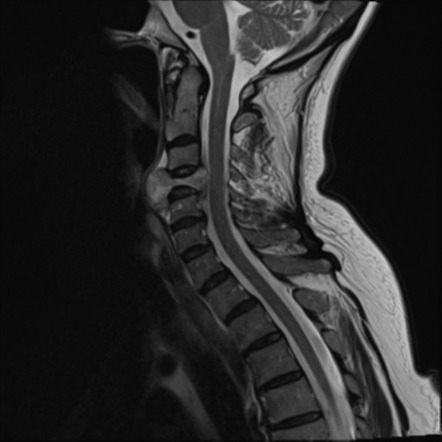 Chordoma | Radiology Reference Article | Radiopaedia.org