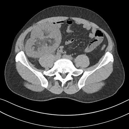 Recurrent IgA nephropathy in transplant kidney | Radiology Case ...