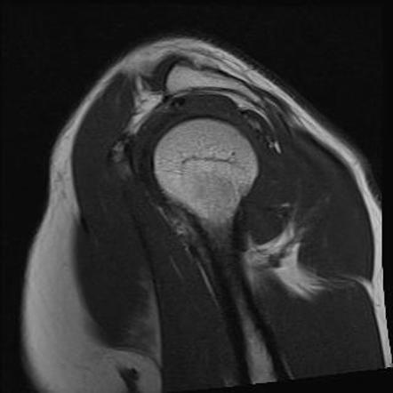 Paraglenoid labral cyst | Radiology Case | Radiopaedia.org