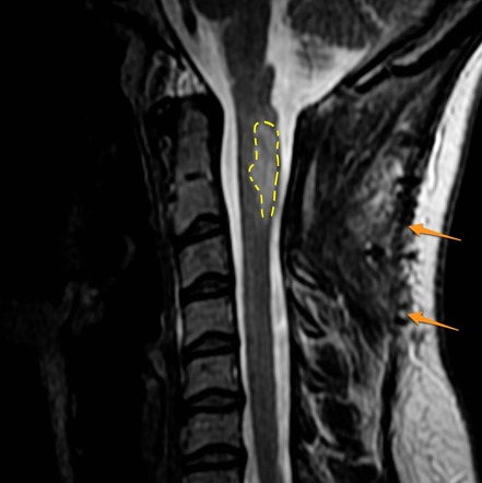 Ganglioglioma - cervical cord | Image | Radiopaedia.org