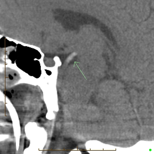 Tip of the basilar thrombosis | Image | Radiopaedia.org