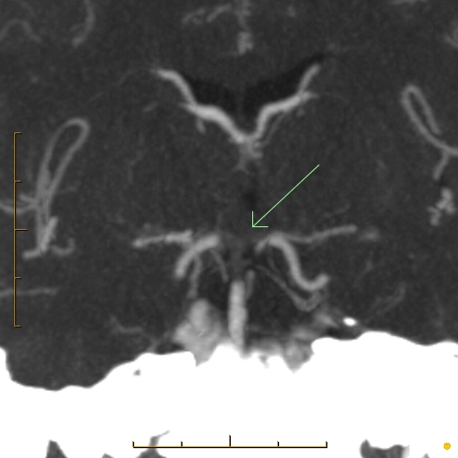 Tip of the basilar thrombosis | Image | Radiopaedia.org