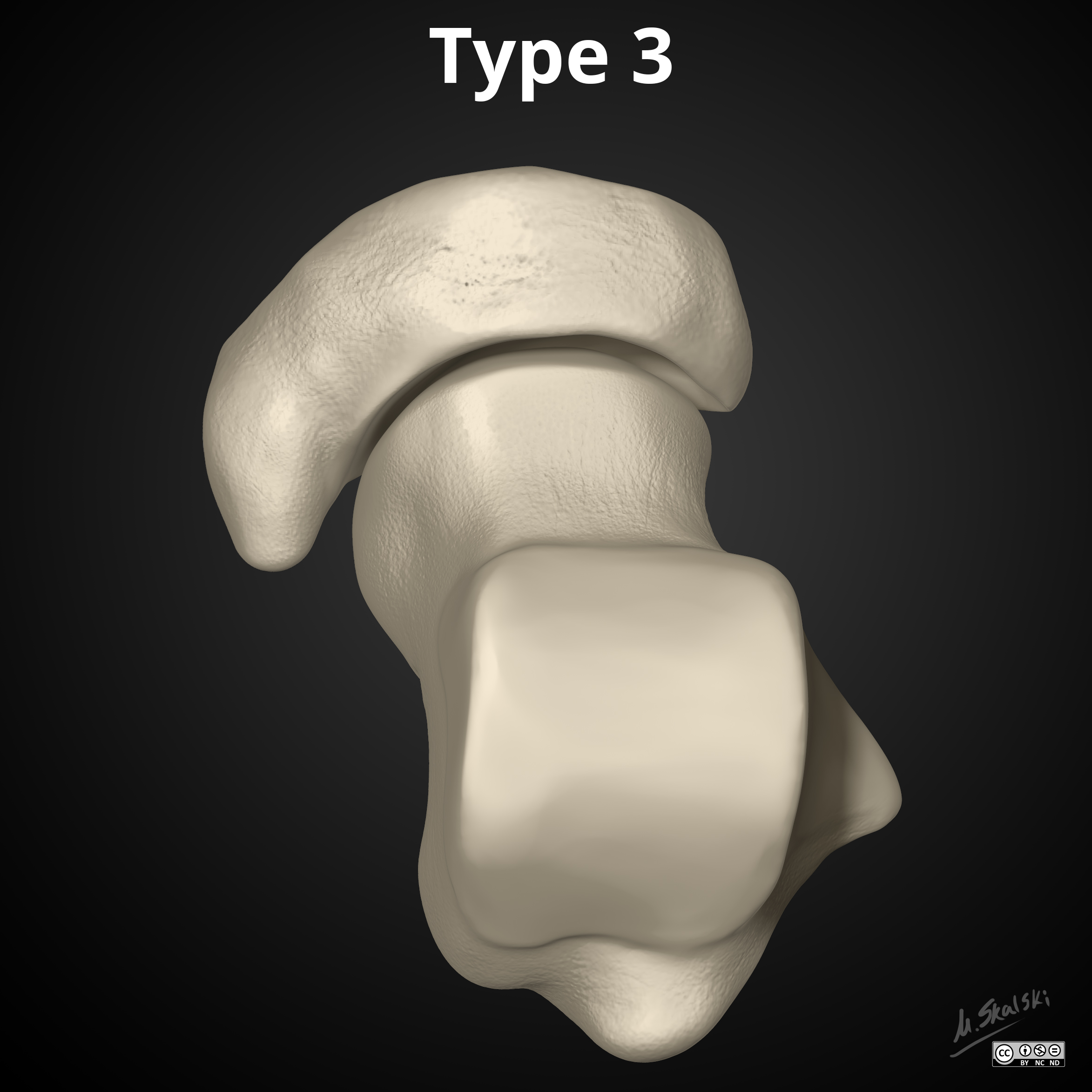 Os naviculare: diagrams | Image | Radiopaedia.org