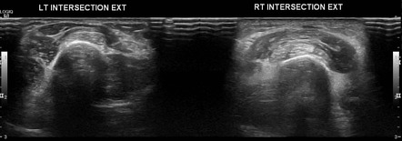 Proximal intersection syndrome | Radiology Reference Article ...