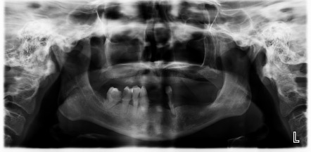 Maxillary sinus mucocele | Radiology Case | Radiopaedia.org